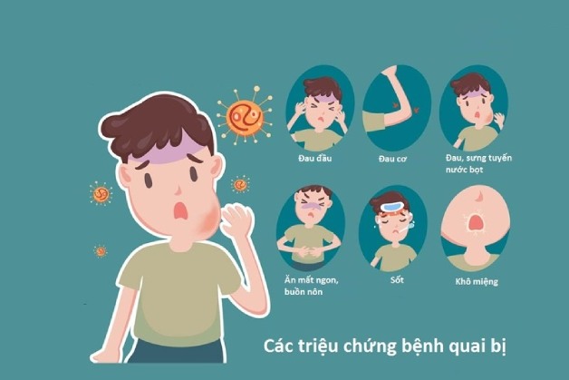 Nắm rõ 3 điều cần biết về việc tiêm phòng quai bị