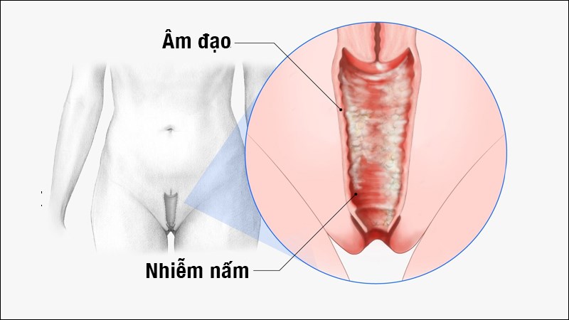 Nấm sợi âm đạo: Nguyên nhân, cách chữa trị và phòng ngừa