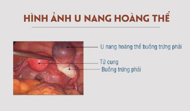 Nang hoàng thể ảnh hưởng thế nào đến phụ nữ mang thai?