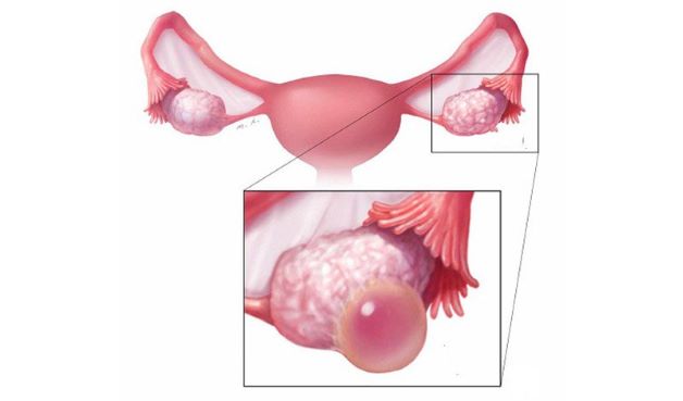 Nang nước cạnh buồng trứng có đáng lo ngại không?