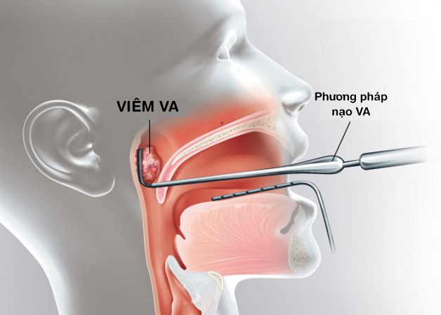 Nạo VA cho bé: Những điều phụ huynh cần biết