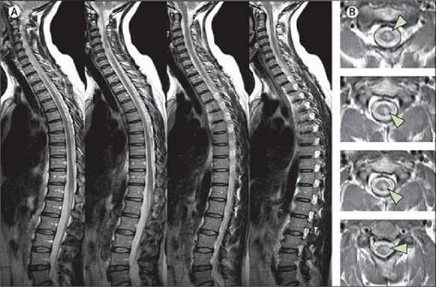 Nên chụp cộng hưởng từ cột sống thắt lưng khi nào?