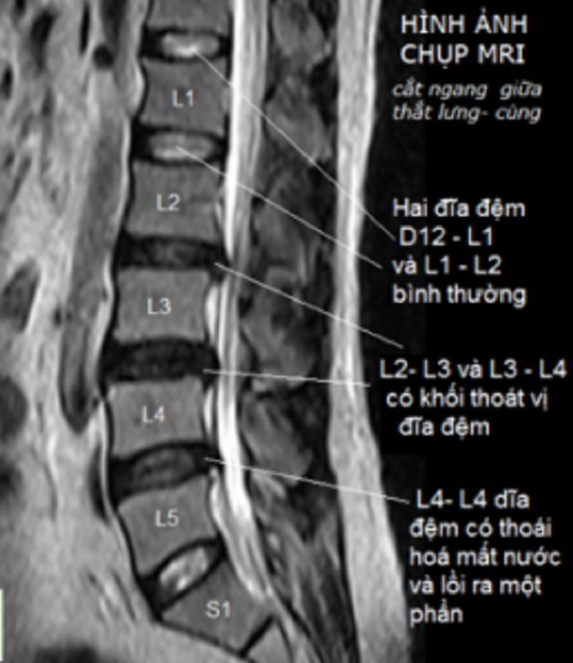 Nên chụp cộng hưởng từ cột sống thắt lưng khi nào?