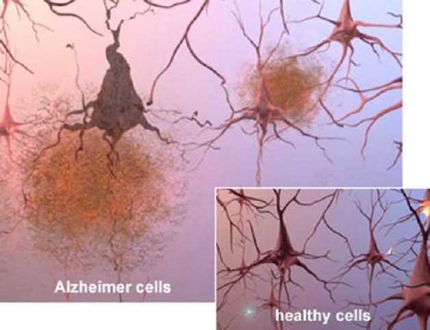 Nên đi khám bệnh Alzheimer ở đâu?