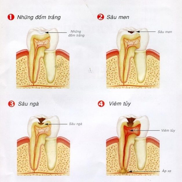 Nên làm gì khi răng bị sâu?