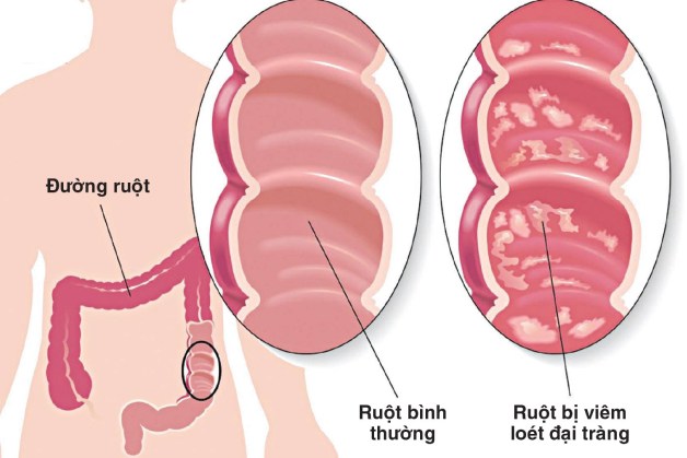 Nên sàng lọc ung thư đại trực tràng nếu mắc các bệnh đường ruột sau