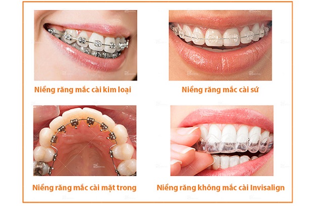 Nẹp răng hô và những điều cần biết 