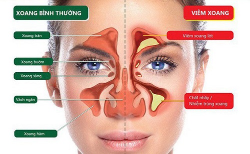 Ngạt mũi lâu ngày là dấu hiệu của bệnh gì?