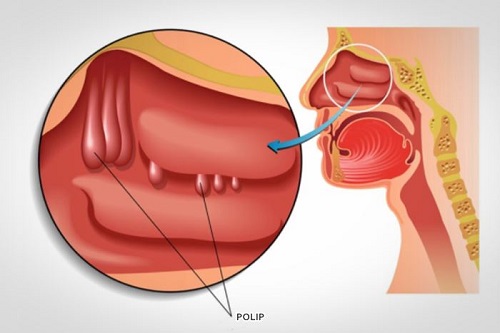 Ngạt mũi lâu ngày là dấu hiệu của bệnh gì?