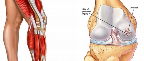 Nghe thấy tiếng lạo xạo khớp gối nghĩ ngay đến bệnh khô khớp