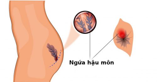 Ngứa hậu môn và những điều cần biết