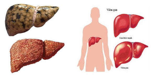 Ngứa khắp người là bệnh gì?  Các nốt mẩn đỏ