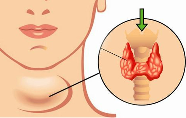 Người bệnh bị u tuyến giáp ăn gì tốt?