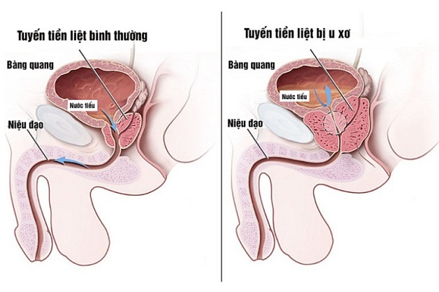 Người bệnh u xơ tiền liệt tuyến có nên mổ không?