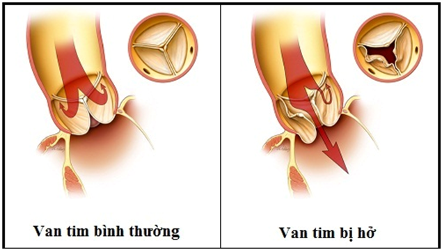 Người bệnh van tim cần lưu ý gì?