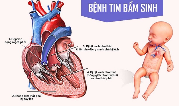 Người bị bệnh tim bẩm sinh sống được bao lâu?