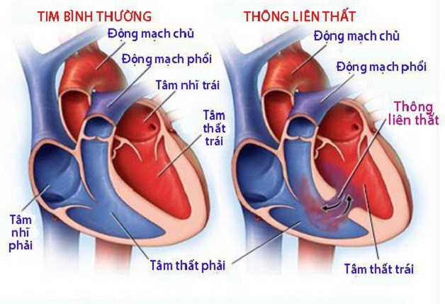 Người bị bệnh tim bẩm sinh sống được bao lâu?