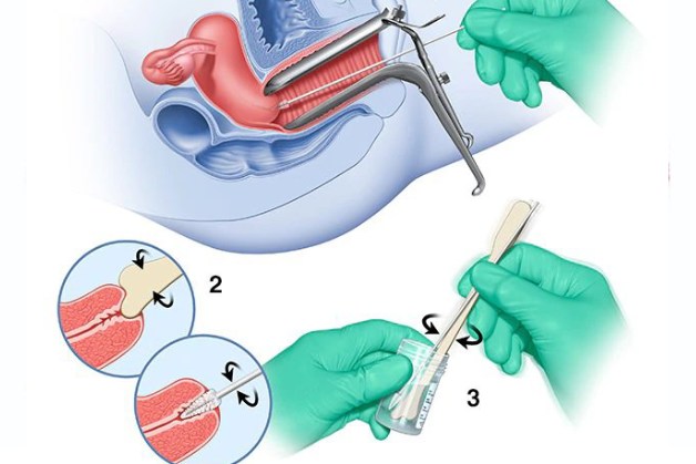 Người bị nhiễm virus HPV có phải tầm soát ung thư cổ tử cung