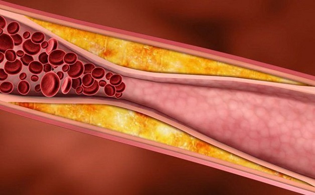 Người bị thiếu máu não nên làm gì để cải thiện sức khỏe?