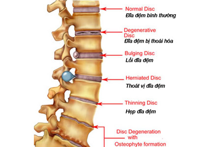 Người bị thoát vị đĩa đệm nên uống thuốc gì?