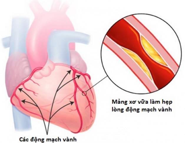 Người mắc bệnh tim mạch vành nên tập luyện như thế nào?