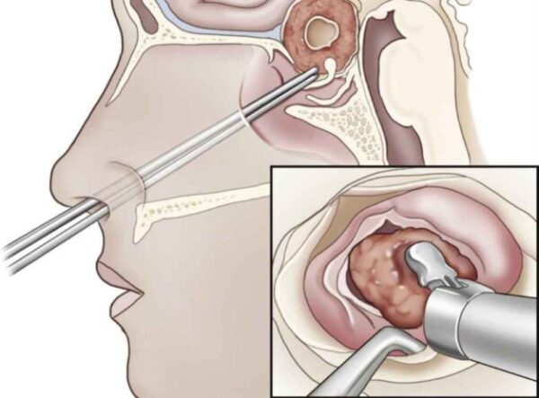 Người mắc u tuyến yên điều trị như thế nào?