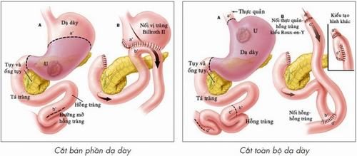 Người mới mổ dạ dày nên ăn gì?