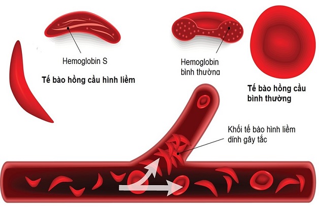 Người trẻ đột quỵ do thiếu máu não ngày càng tăng