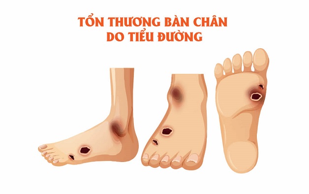 Nguy cơ cắt cụt chi do biến chứng bệnh đái tháo đường