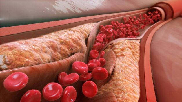 Nguy cơ đột quỵ não do không kiểm soát tốt cholesterol xấu