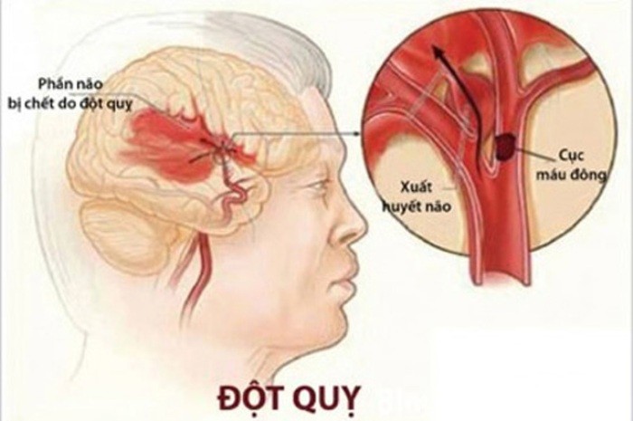 Nguy cơ đột quỵ từ cơn thiếu máu não thoáng qua