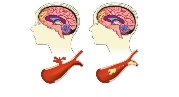 Nguy cơ gây đột quỵ và cách kiểm soát