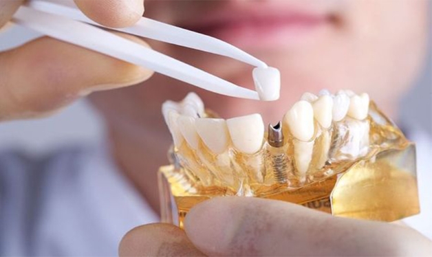 Nguy cơ khi lựa chọn nha khoa cấy ghép Implant không uy tín