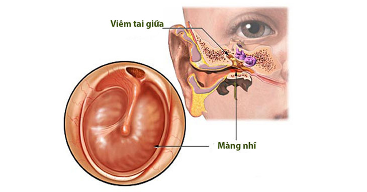 Nguy cơ mất thính giác khi bị viêm tai giữa vỡ mủ