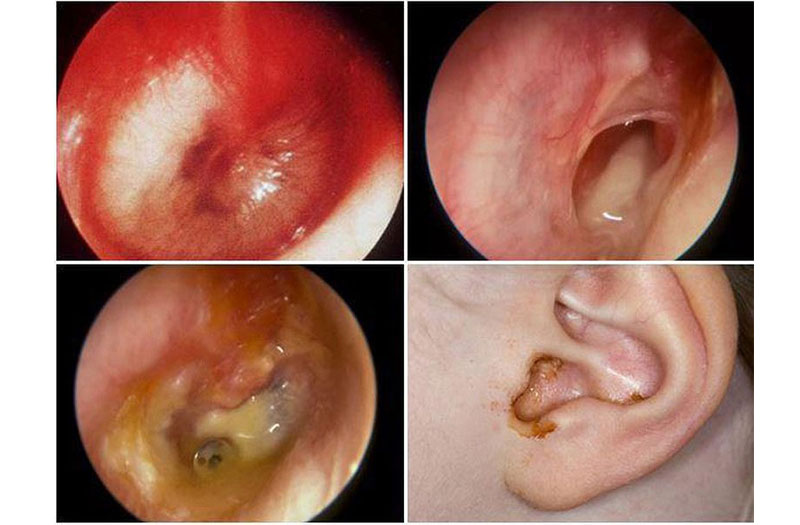 Nguy cơ mất thính giác khi bị viêm tai giữa vỡ mủ