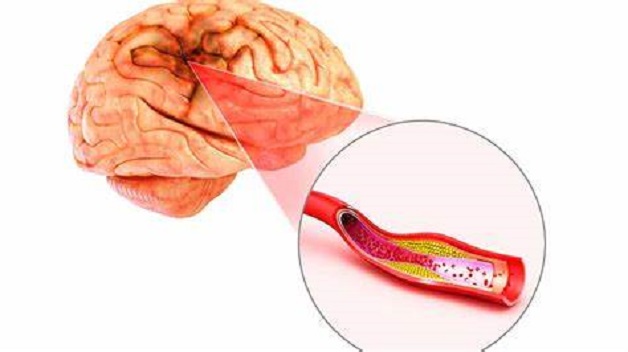 Nguy cơ tai biến mạch máu não ở các đối tượng sau