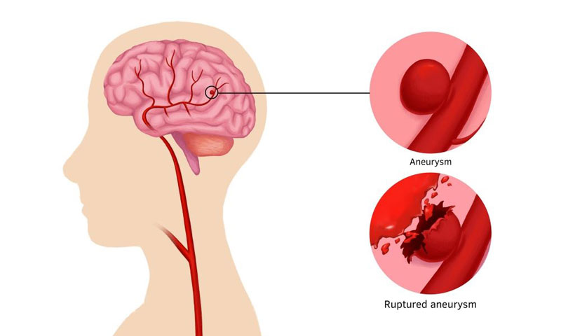 Nguy cơ vỡ mạch máu não khi đột quỵ do tăng huyết áp