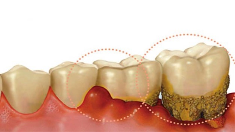 Nguy hại khôn lường từ những mảng bám răng lâu ngày