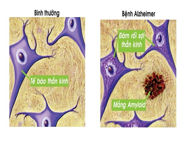 Nguyên nhân Alzheimer vẫn còn bỏ ngỏ 