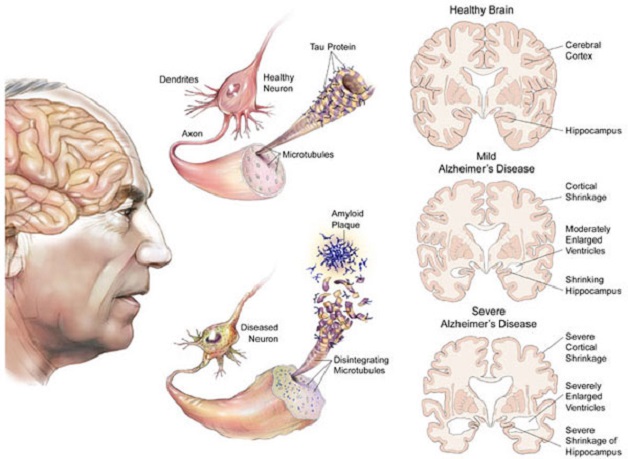 Nguyên nhân Alzheimer vẫn còn bỏ ngỏ 