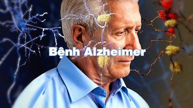 Nguyên nhân Alzheimer vẫn còn bỏ ngỏ 