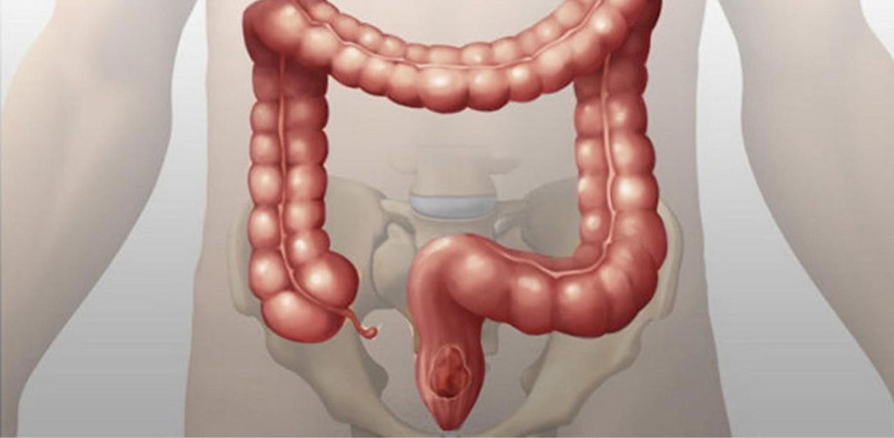 Nguyên nhân bệnh Crohn gây triệu chứng đau ruột già 