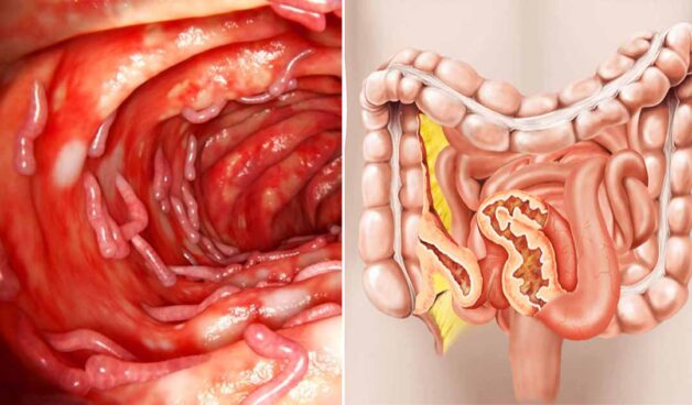 Nguyên nhân bệnh Crohn gây triệu chứng đau ruột già 