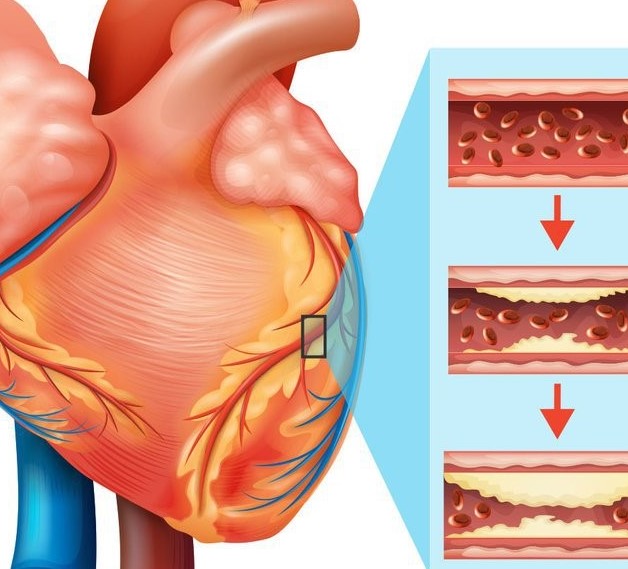 Nguyên nhân bệnh mạch vành và cách điều trị cần biết