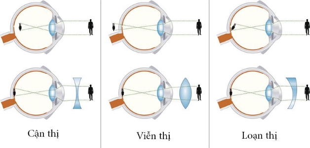 Nguyên nhân bệnh viễn thị và cách chữa viễn thị hiệu quả