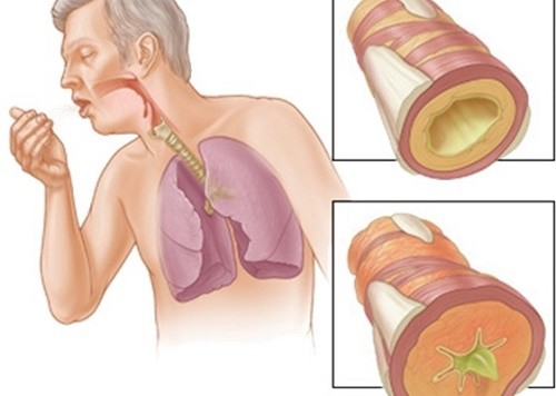 Nguyên nhân bệnh xơ phổi, chuẩn đoán điều trị bệnh xơ phổi