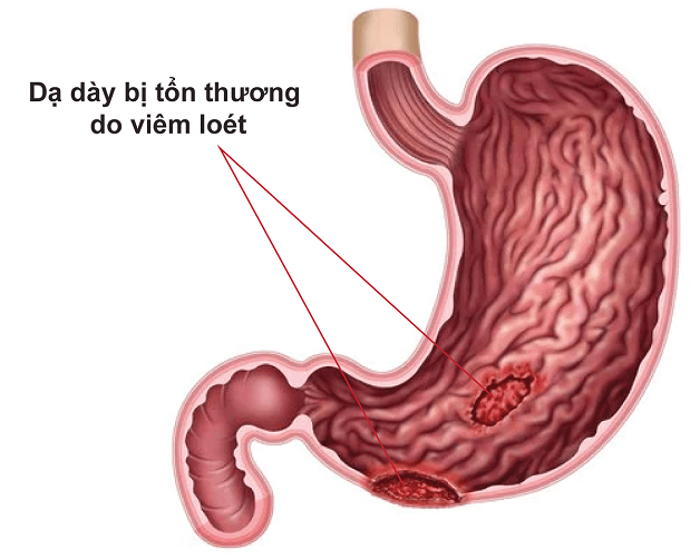 Nguyên nhân bị loét dạ dày, triệu chứng và cách điều trị