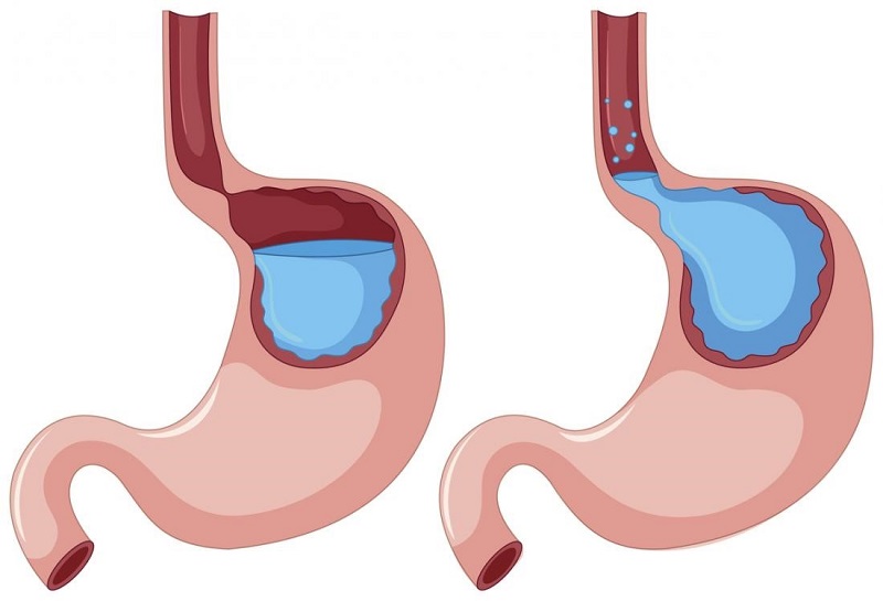 Nguyên nhân bị ợ hơi là gì và cách phòng tránh