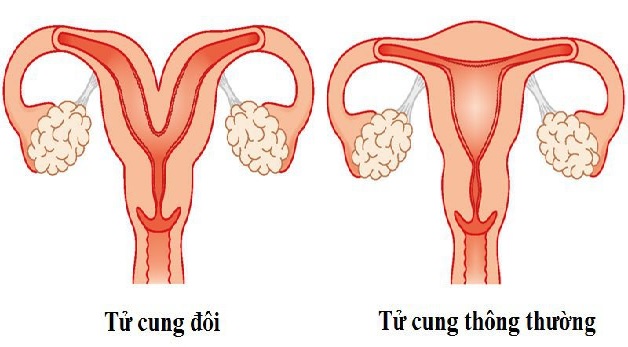 Nguyên nhân bị tử cung đôi và cách điều trị an toàn