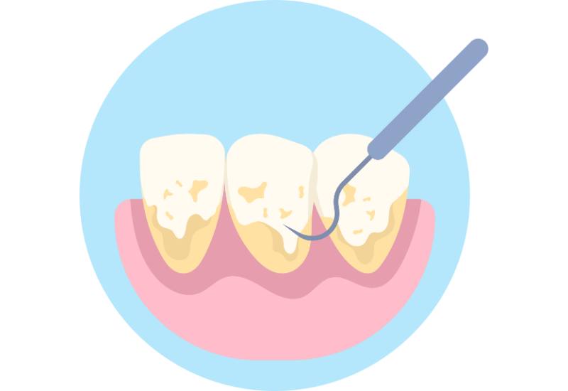 Nguyên nhân bị vôi răng và cách dự phòng